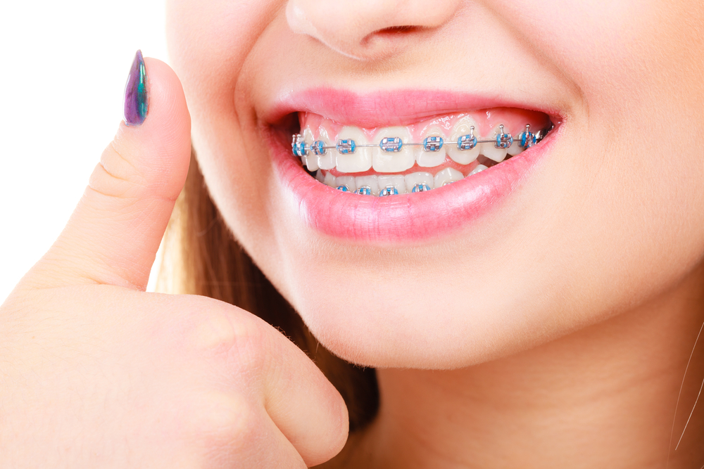 traditional braces