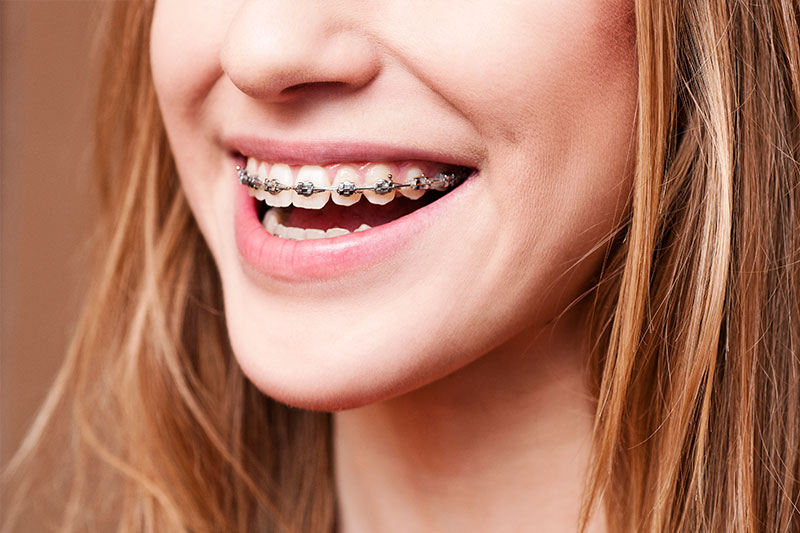 Peninsula Orthodontics Special Offer